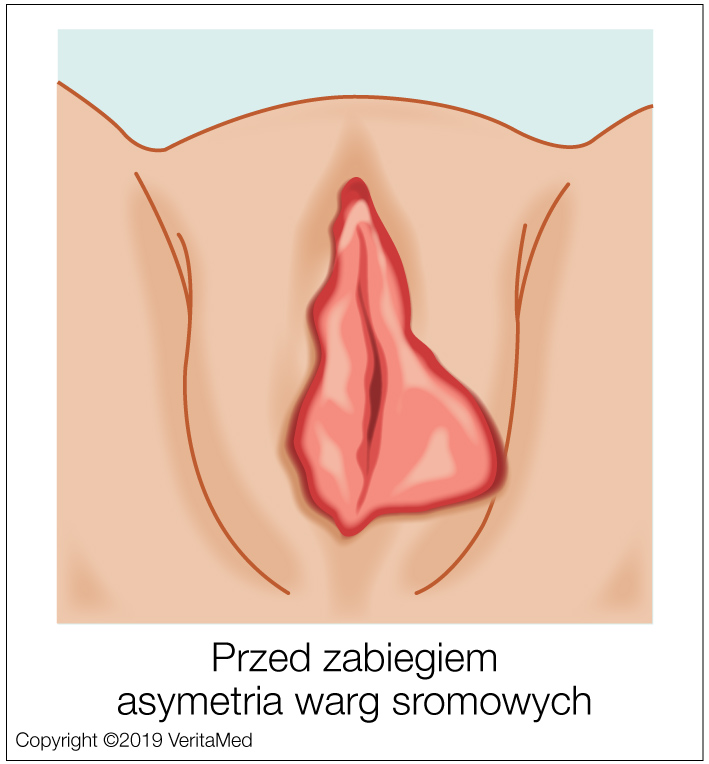 Labioplastyka - PRZED ZABIEGIEM closeup - asymetria warg sromowych pr - VeritaMed.jpg
